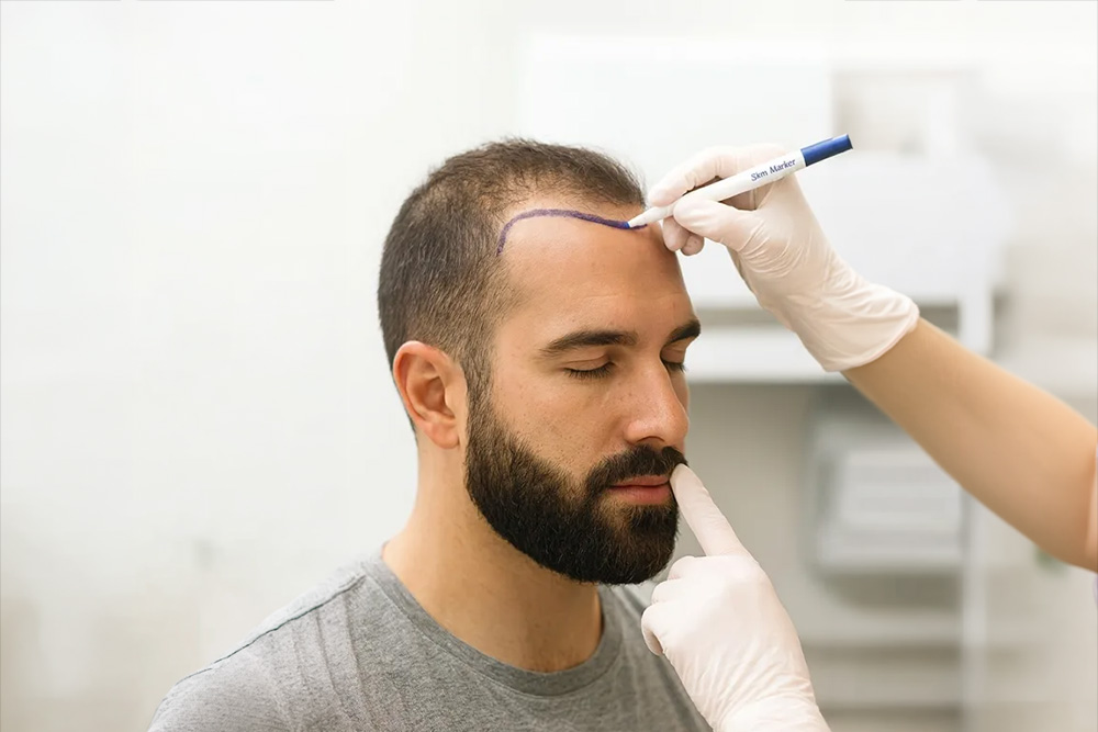Sesión de bioestimulación capilar en Estética Sur